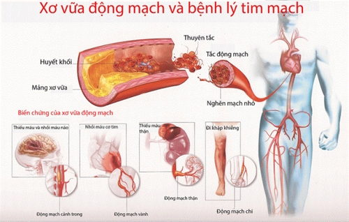 Sơ vữa động mạch và các bệnh lý tim mạch